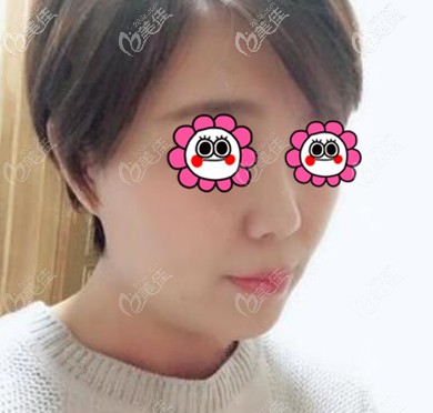 从我做耳软骨复合隆鼻一个月的恢复过程图来告诉你沈阳名流隆鼻技术怎么样