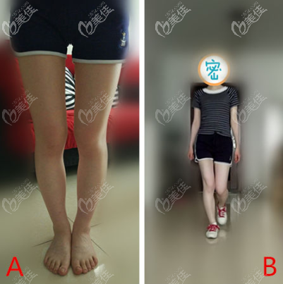 O型腿矫正案例图