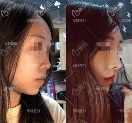 重庆军科医院鼻综合案例