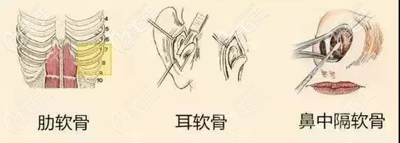 隆鼻常用的自体软骨