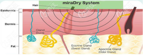 MiraDry微波腋臭治疗示意图