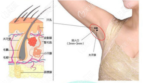 光纤治疗腋臭 光纤治疗腋臭