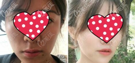 我花22000块做的人中缩短术恢复三个月效果对比照片
