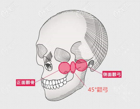 颧骨颧弓决定磨颧骨还是颧骨内推 颧骨颧弓决定磨颧骨还是颧骨内推