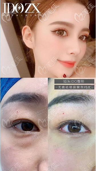 汕头爱都沪美人不愧是汕头网红整形医院,张贤期医生做的双眼皮祛眼袋效果超好看