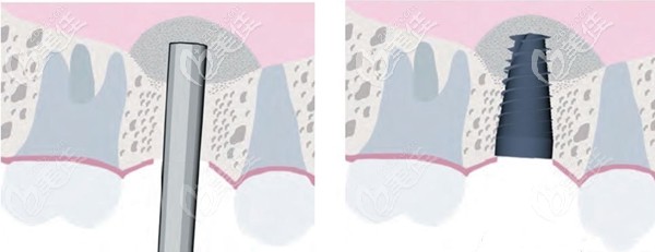 上颌窦内外提升术的区别 上颌窦内外提升术的区别