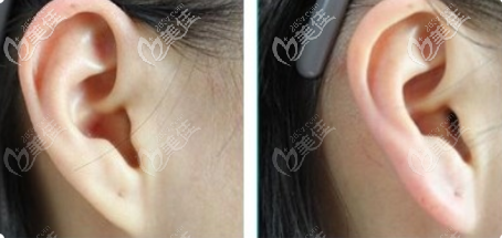 我做的玻尿酸丰耳垂的前后对比效果展示 我做的玻尿酸丰耳垂的前后对比效果展示
