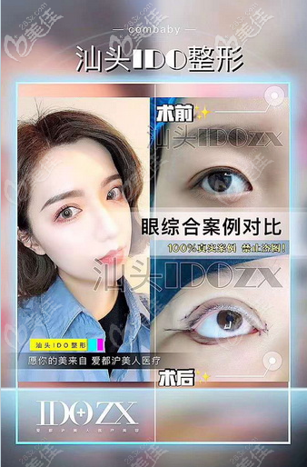 看汕头爱都沪美人张贤期医生做双眼皮怎么样 看汕头爱都沪美人张贤期医生做双眼皮怎么样