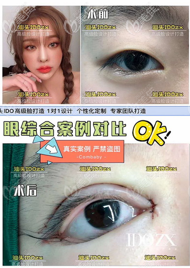 汕头爱都沪美人双眼皮案例 汕头爱都沪美人双眼皮案例