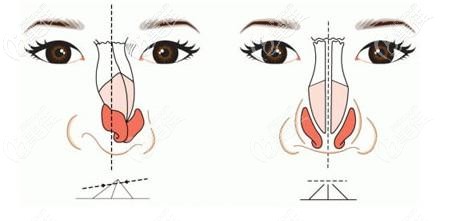 假体隆鼻歪斜修复手术