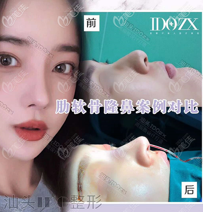 汕头爱都沪美人张贤期医生隆鼻案例 汕头爱都沪美人张贤期医生隆鼻案例