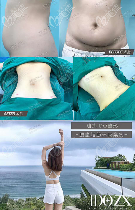 汕头爱都沪美人张贤期医生吸脂手术案例 汕头爱都沪美人张贤期医生吸脂手术案例