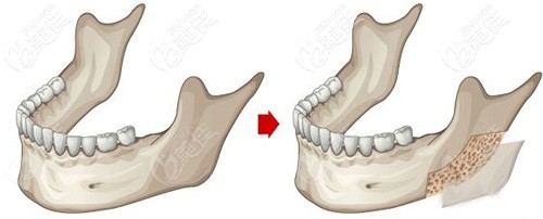 下颌角磨骨的手术示意图