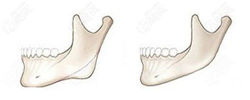 下颌角截骨的手术原理图