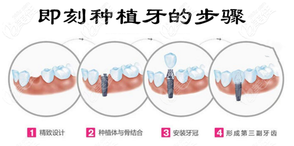 即刻种植牙当天就能用吗？