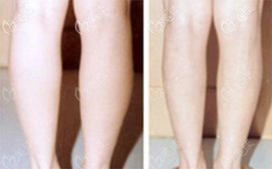 小腿抽脂术前术后照片对比