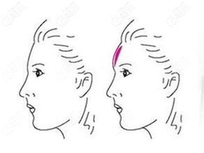 自体脂肪丰额头效果 自体脂肪丰额头效果