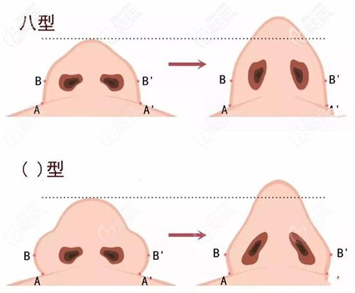 鼻翼肥大的类型