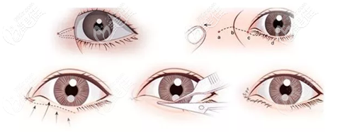 开眼角手术过程 开眼角手术过程