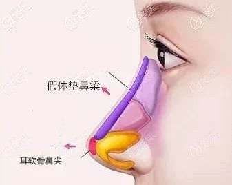隆鼻假体垫鼻梁+耳软骨垫鼻尖 隆鼻假体垫鼻梁+耳软骨垫鼻尖
