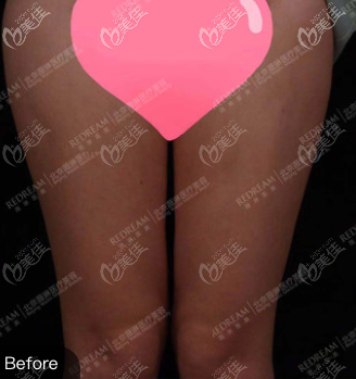 找北京做大腿环吸好的薇琳医院做手术前 找北京做大腿环吸好的薇琳医院做手术前