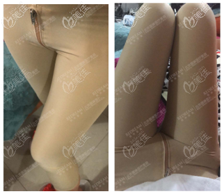 在北京做完大腿环吸第21天 在北京做完大腿环吸第21天