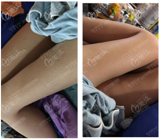 <!--<i data=20240703-sp></i>-->给我做大腿环吸45天案例效果 <!--<i data=20240703-sp></i>-->给我做大腿环吸45天案例效果