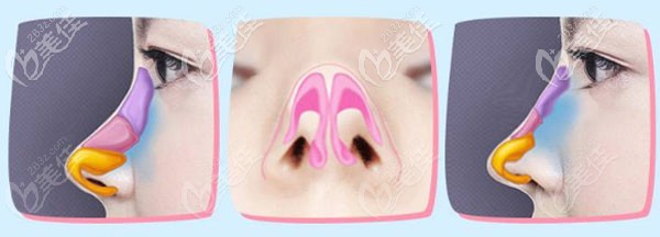 美丽星医美做肋软骨技术优势 美丽星医美做肋软骨技术优势