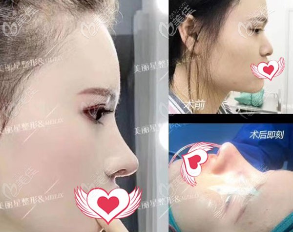 南宁美丽星整形肋软骨隆鼻一个月的恢复<span style= 南宁美丽星整形肋软骨隆鼻一个月的恢复<span style=