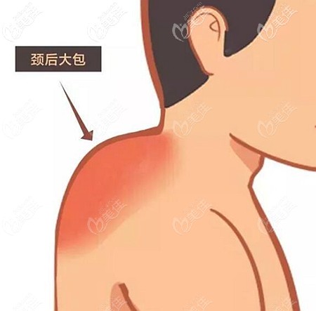 富贵包的形成原因和消除方式