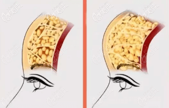 面部脂肪填充过多示意图