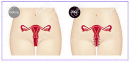 自体脂肪填充缩阴效果好吗 自体脂肪填充缩阴效果好吗