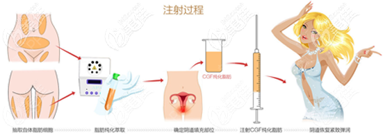 自体脂肪填充缩阴过程示意图 自体脂肪填充缩阴过程示意图