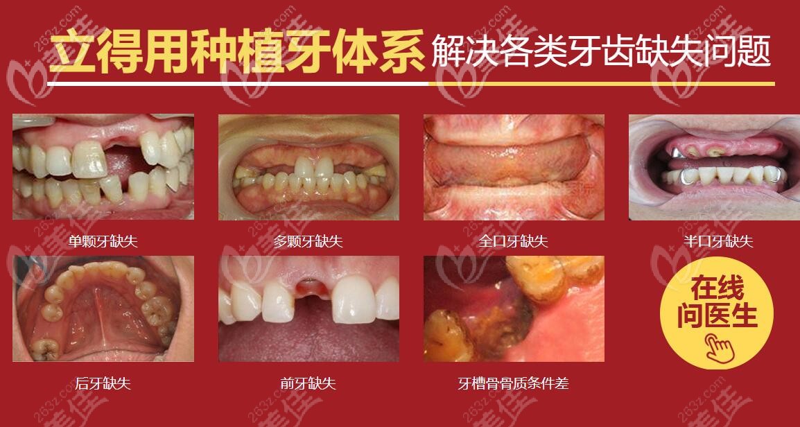中诺口腔立得用种植牙体系能解决很多牙齿问题 中诺口腔立得用种植牙体系能解决很多牙齿问题