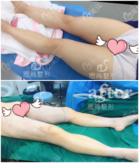 大腿吸脂前后对比案例 大腿吸脂前后对比案例