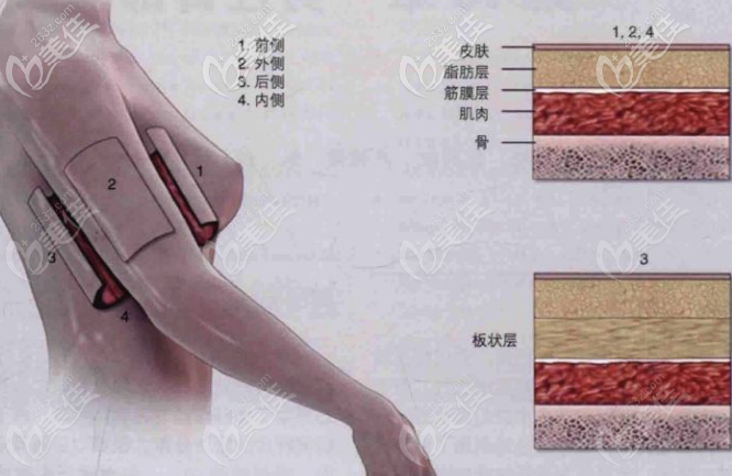 手臂环吸包含哪几个部位 手臂环吸包含哪几个部位