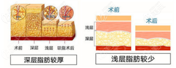 北京南加整形医院吸脂技术优势 北京南加整形医院吸脂技术优势