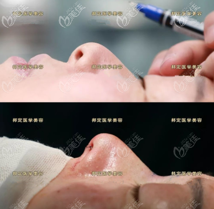 北京张艳华医生鼻综合案例 北京张艳华医生鼻综合案例