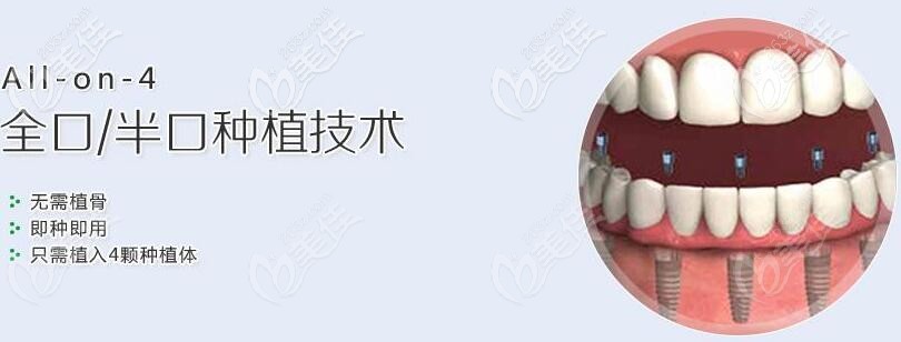 广州穗江口腔何荣冰allon4种植牙 广州穗江口腔何荣冰allon4种植牙
