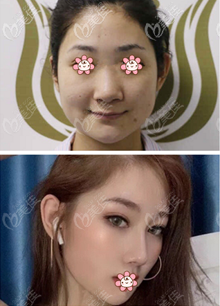 我在北京邦定做的隆鼻案例照片