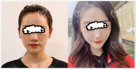 贵阳华美赵峰隆鼻案例：恢复三个月后鼻子挺翘自然