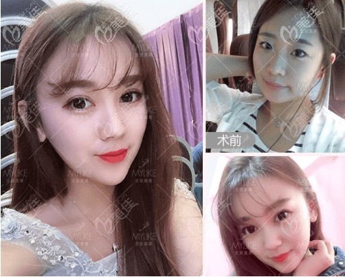 我找北京美莱做鼻子好的牛永敢医生做的隆鼻案例 我找北京美莱做鼻子好的牛永敢医生做的隆鼻案例