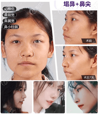 北京美莱做鼻子好的王旭东医生半肋鼻综合案例你觉得怎么样 北京美莱做鼻子好的王旭东医生半肋鼻综合案例你觉得怎么样