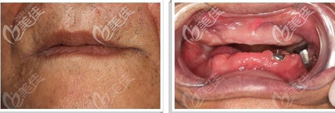 牙管家口腔满口无牙案例 牙管家口腔满口无牙案例