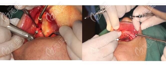 北京牙管家全口牙种植手术