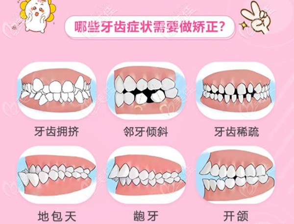 广州穗江口腔牙齿矫正适应症