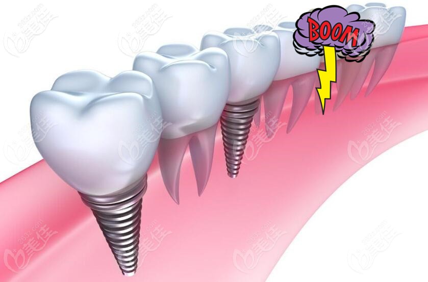 种植牙图示 种植牙图示