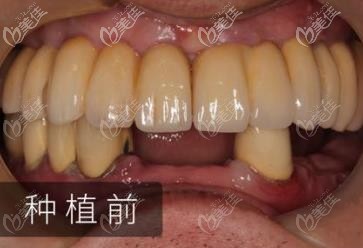 种牙前的我 种牙前的我