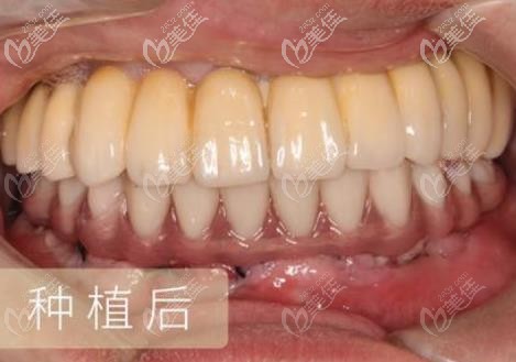 种植牙后的效果图 种植牙后的效果图