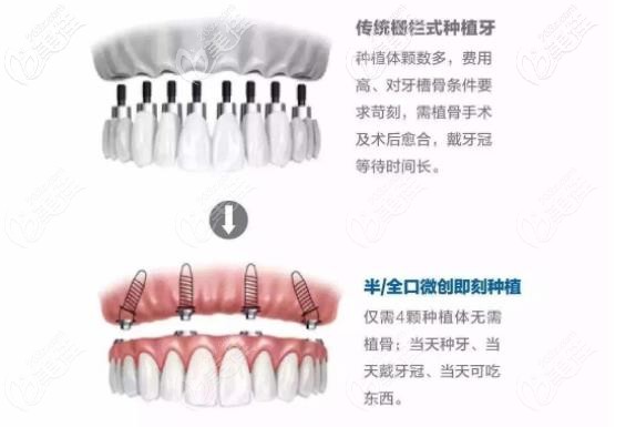 传统种植牙和即刻种植区别 传统种植牙和即刻种植区别